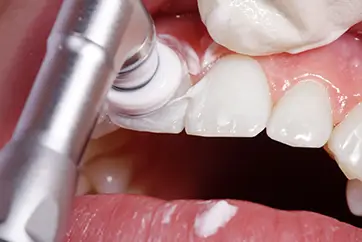 歯科衛生士による口内クリーニング